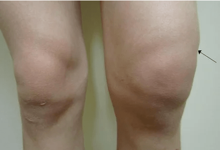 Hemarthrosis of the knee joint