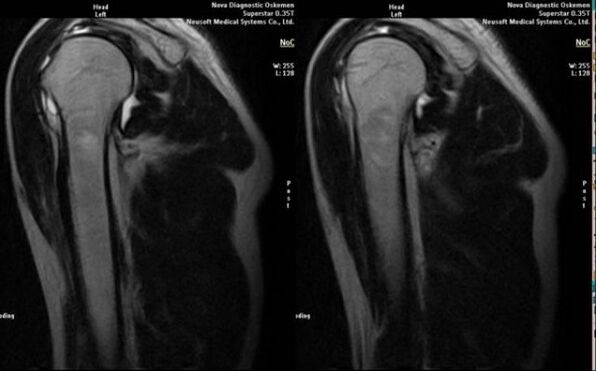X-ray to diagnose shoulder arthrosis