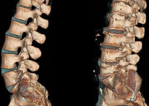 osteocondrose