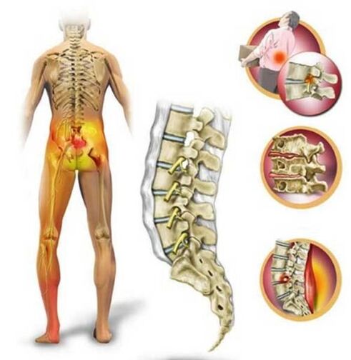 Osteochondrosis of the lumbar spine, causing back pain
