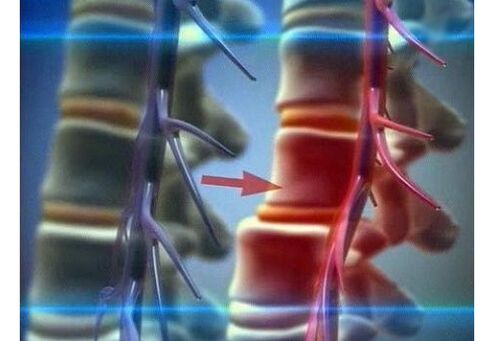 Squeezing nerve endings in lumbar osteochondrosis