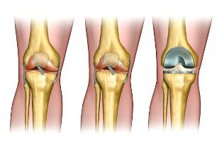 the extent of the arthritis